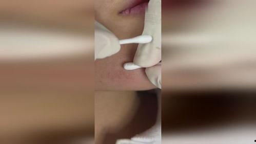 看挤粉刺视频,专业技巧与注意事项